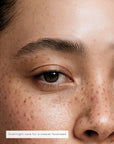 FOREHEAD PATCHES