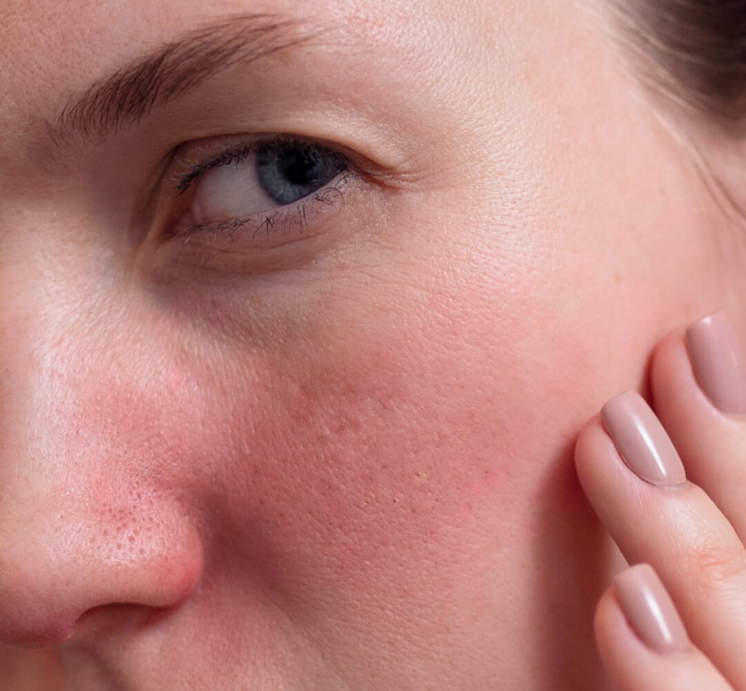 The Real Causes of Redness, Flushing, and Irritation